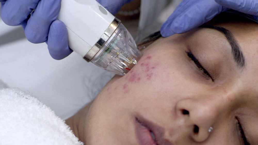 Uncover the Maximum Efficient Pimples Scar Remedies for Transparent, Clean Pores and skin – Your Clinical Forestall
