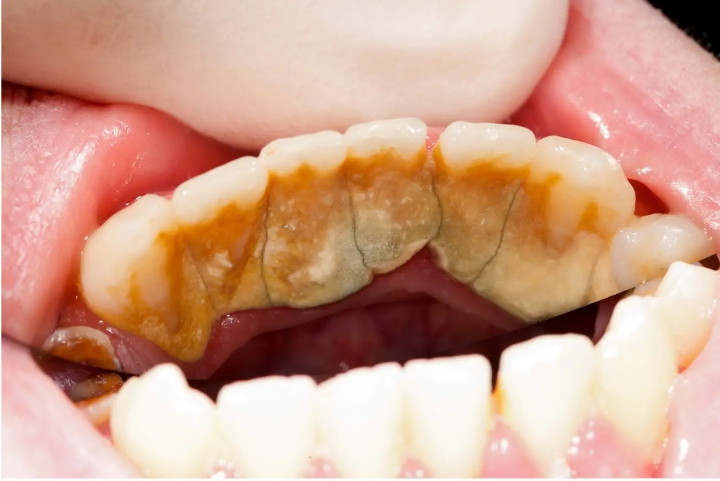 Defeating Dental Plaque: Empowering Pointers for Optimum Oral Hygiene – Your Clinical Prevent